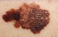 dermoscopia digitale melanoma